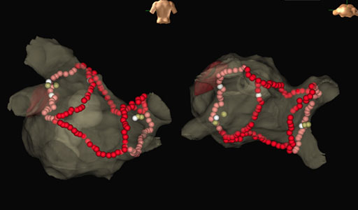 不整脈治療の3Dマッピング画像