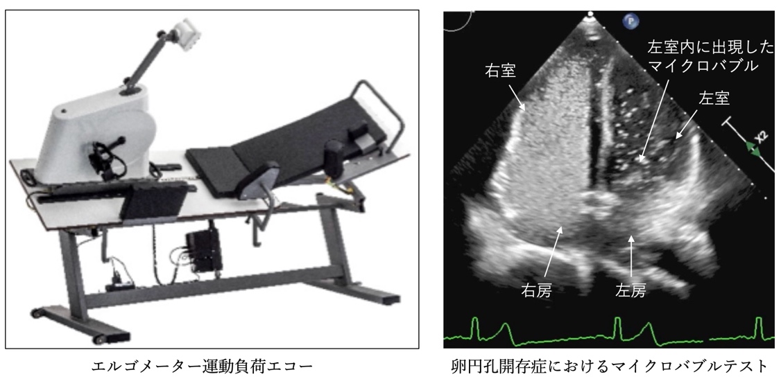 負荷エコー検査とバブルテストの画像