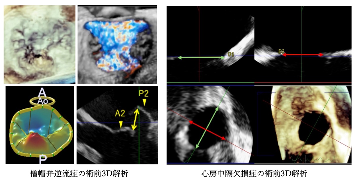 経食道心エコー検査と3D解析の画像