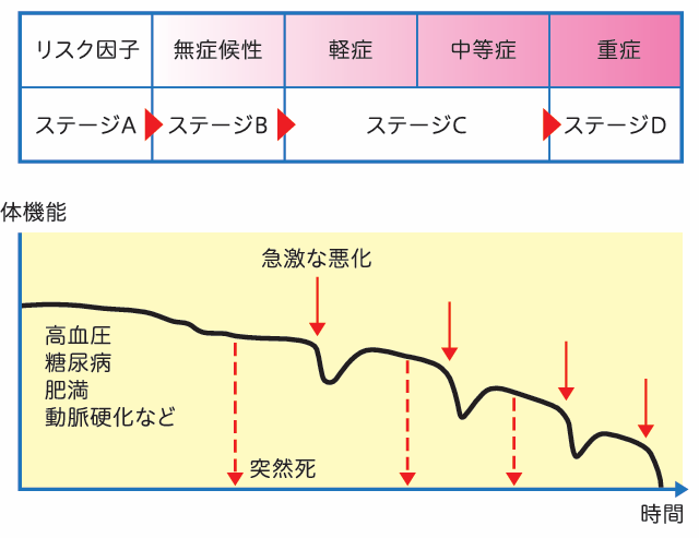 心不全のステージ分類を示す図