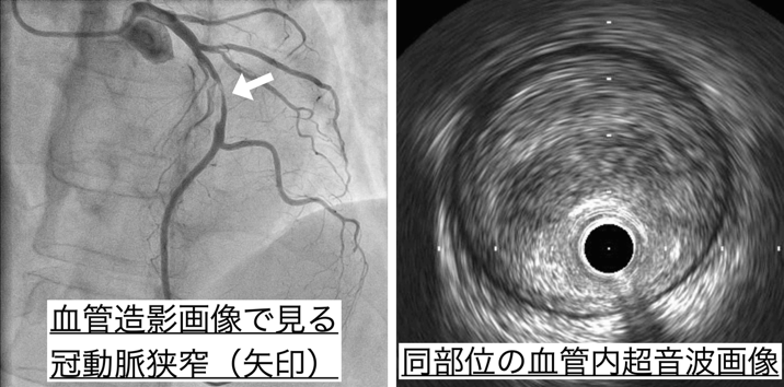 血管造影画像で見る冠動脈狭窄と同部位の血管内超音波画像